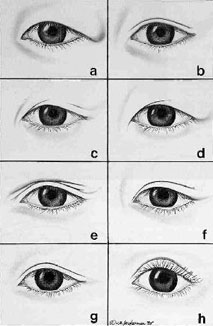 Asian Eyelid Surgery Center - cosmetic and asian double eyelid surgery