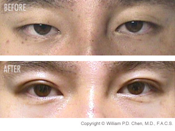 asian eyelid surgery gallery image